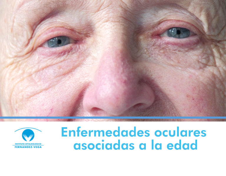 Las Enfermedades Oculares Asociadas A La Edad Blog Fv 8619