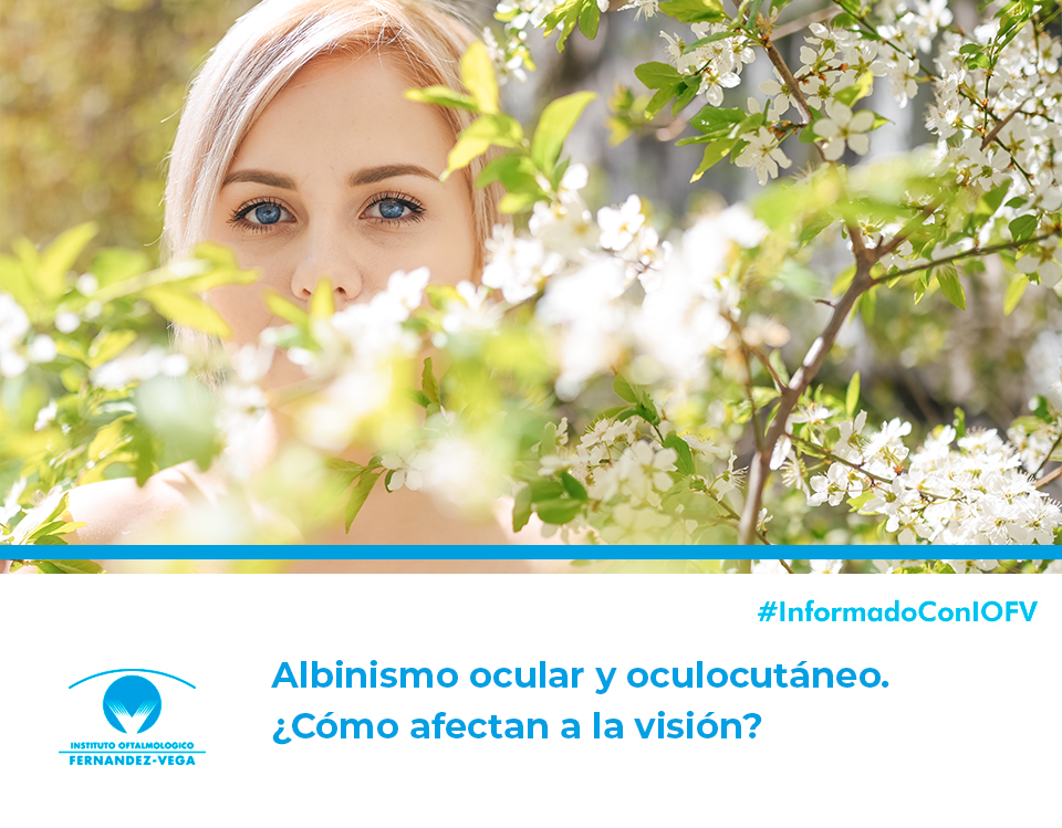 ¿Qué es el albinismo ocular y cómo afecta a la visión?