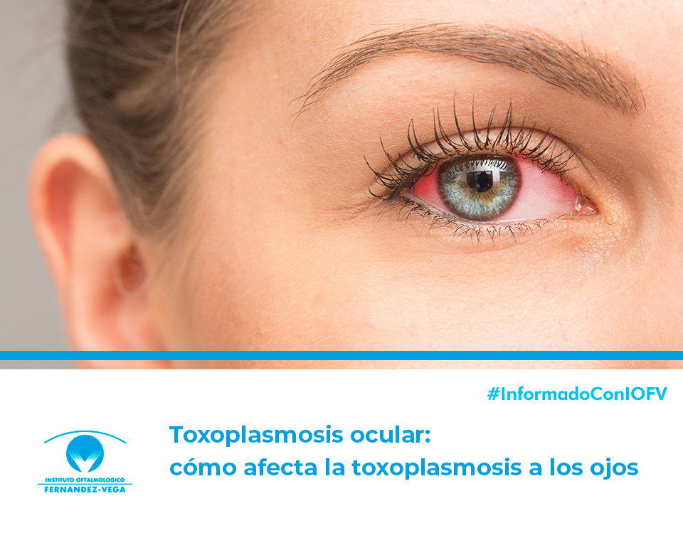 Toxoplasmosis ocular: cómo afecta la toxoplasmosis a los ojos