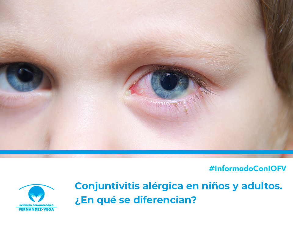 Conjuntivitis alérgica en niños y adultos. ¿En qué se diferencian?