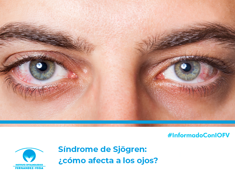 Síndrome de Sjögren: ¿cómo afecta a los ojos?