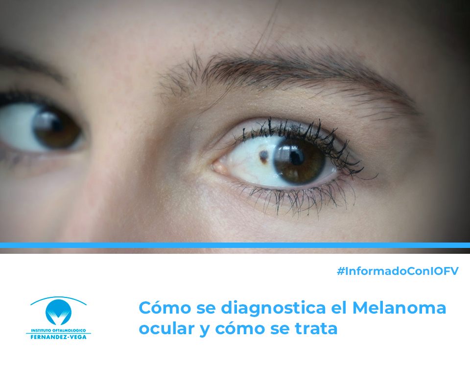 Así es el diagnóstico y el tratamiento del melanoma ocular