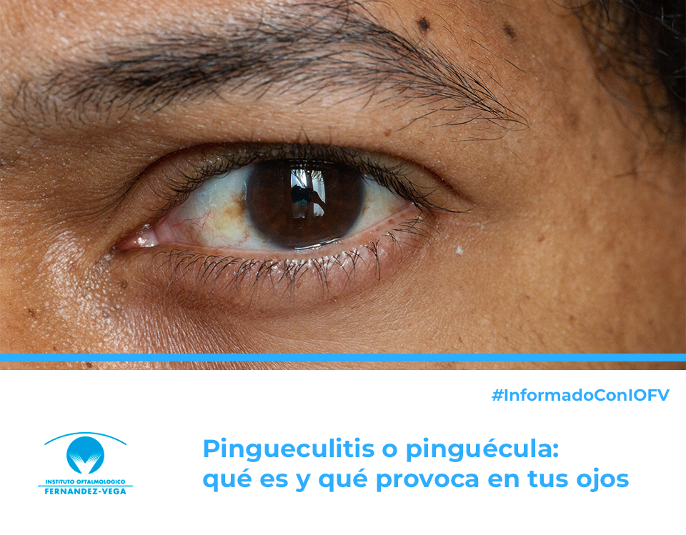 Pingueculitis o pinguécula: qué es y qué provoca en tus ojos