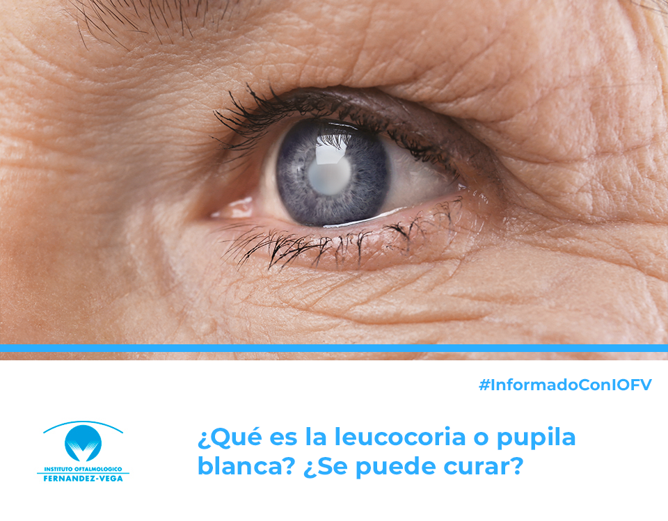 Leucocoria o pupila blanca: qué es y qué otras enfermedades esconde