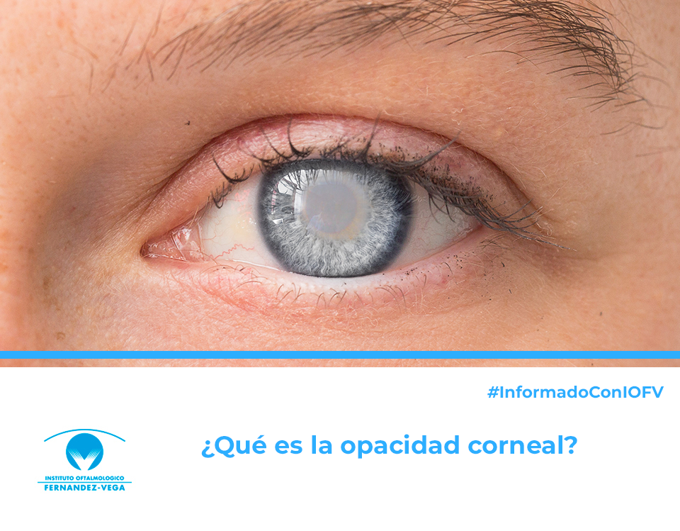 Opacidad corneal: cuándo se produce y cómo tratarla